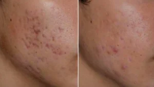 Acne Scar Laser