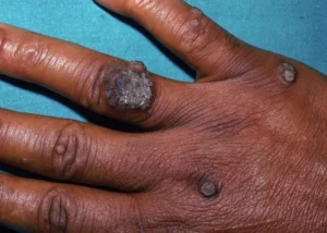 warts