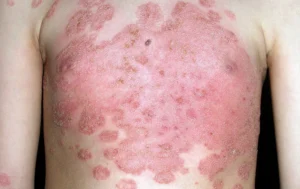 fungal infection