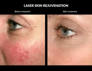Laser Rejuvenation