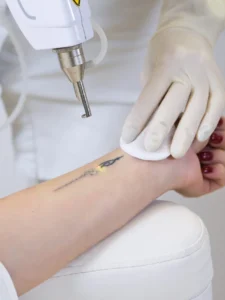 Tattoo Removal Laser